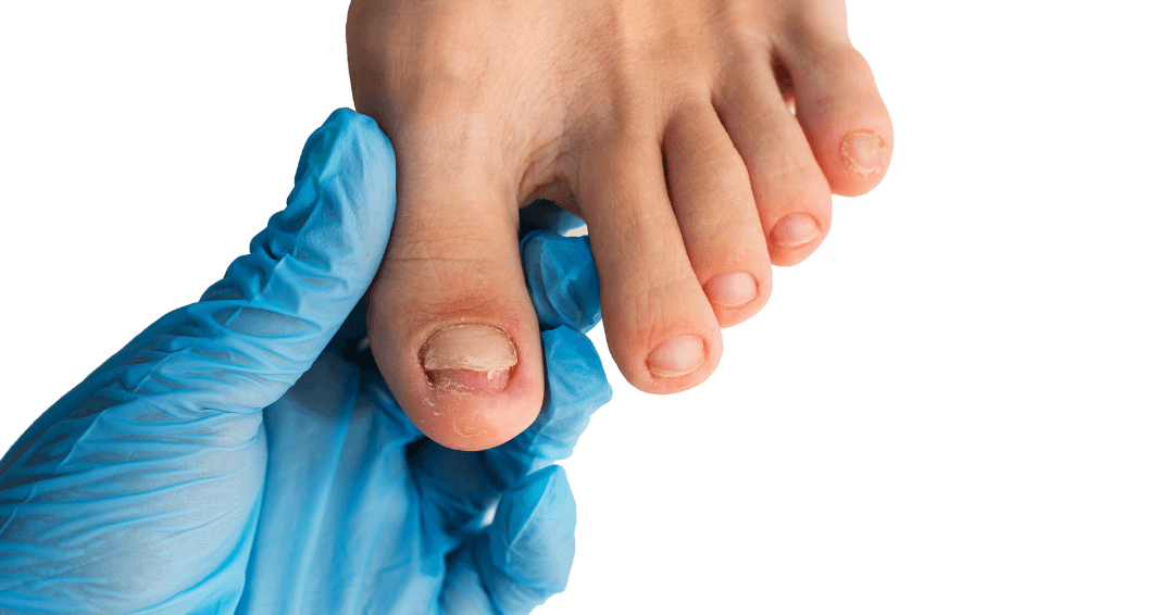 Fungal infection assessment