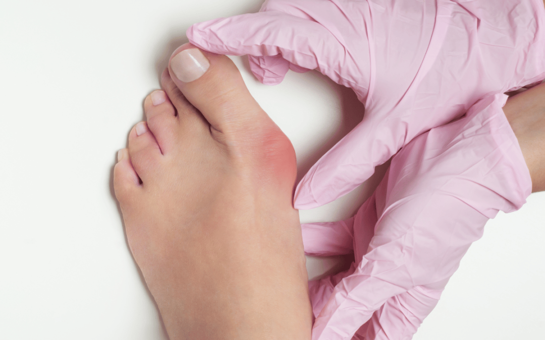 Book Your 65% Off Expert Bunion Assessment